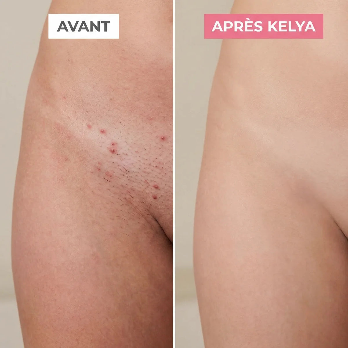 La solution douce pour toutes les zones sensibles